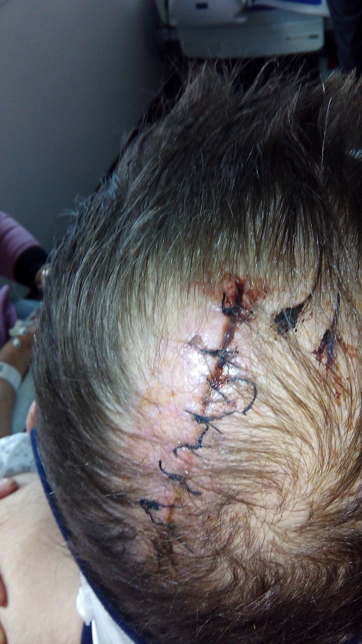 An image of Doug#'s head injury
